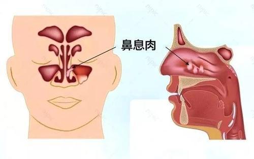 鼻息肉断根秘方_临床验证过的鼻息肉偏方_根除鼻息肉的偏方